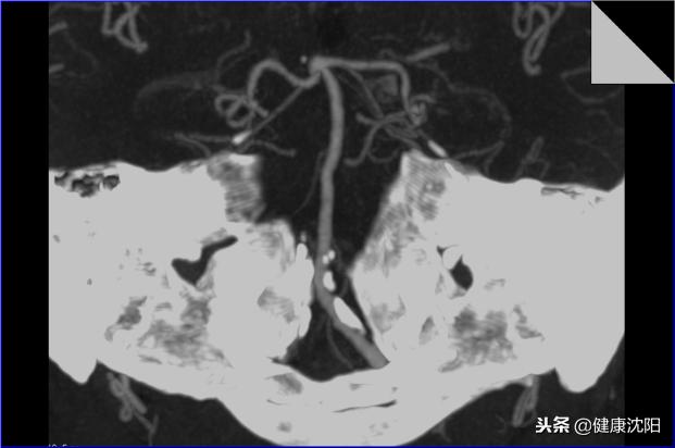 cta和血管造影怎么选择,血管oct检查与血管造影检查的区别