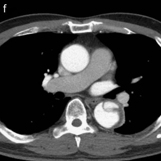 如何监测动脉夹层早期,动脉增强ct能查出主动脉夹层么