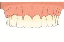 缺一颗牙有必要种植吗,缺了一颗牙可以做矫正吗
