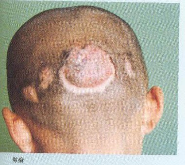 远离真菌感染,夏天常见的皮肤真菌病