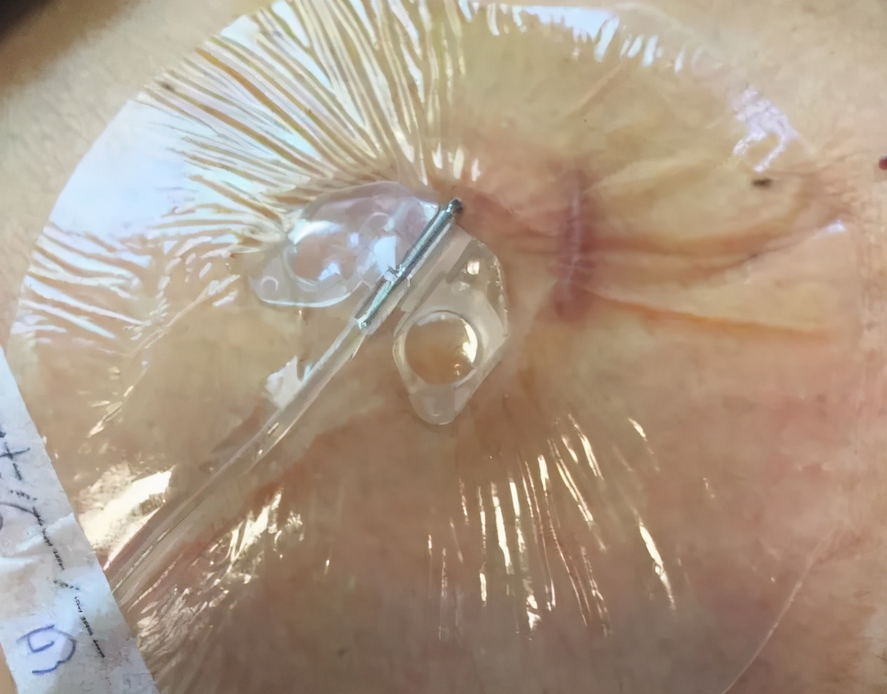 腹腔输液港植入术,植入式专用静脉输液港