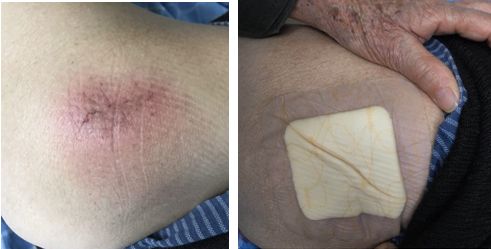 压疮液体敷料怎么用,压疮的治疗首选敷料