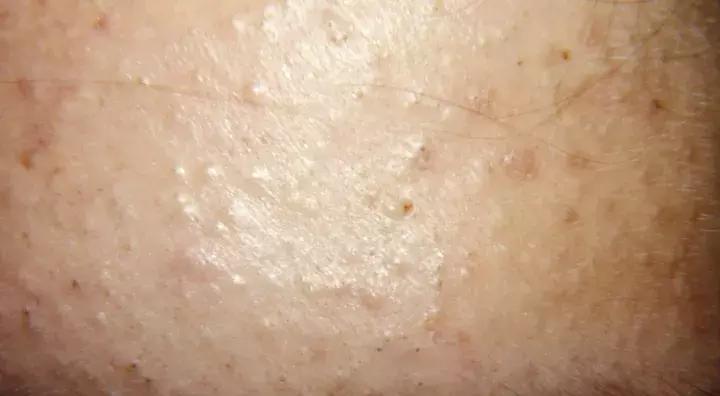 脸上额头一直反复有痘痘怎么办,脸颊的小痘痘一直不好