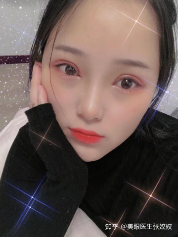 有没有割过眼袋后悔的,肿眼泡割双眼皮后悔率