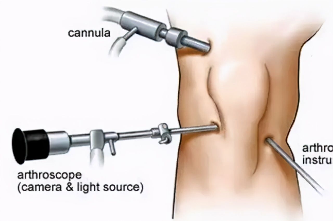 微创膝关节关节镜手术,关节鼠手术
