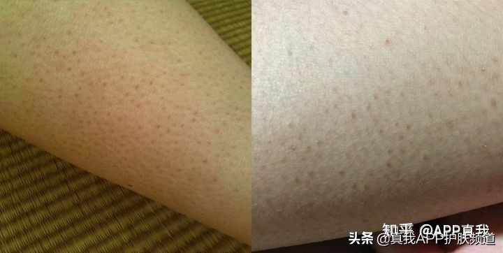 天生遗传鸡皮肤能改善？只需两步基础护理，使用产品均价不超50块