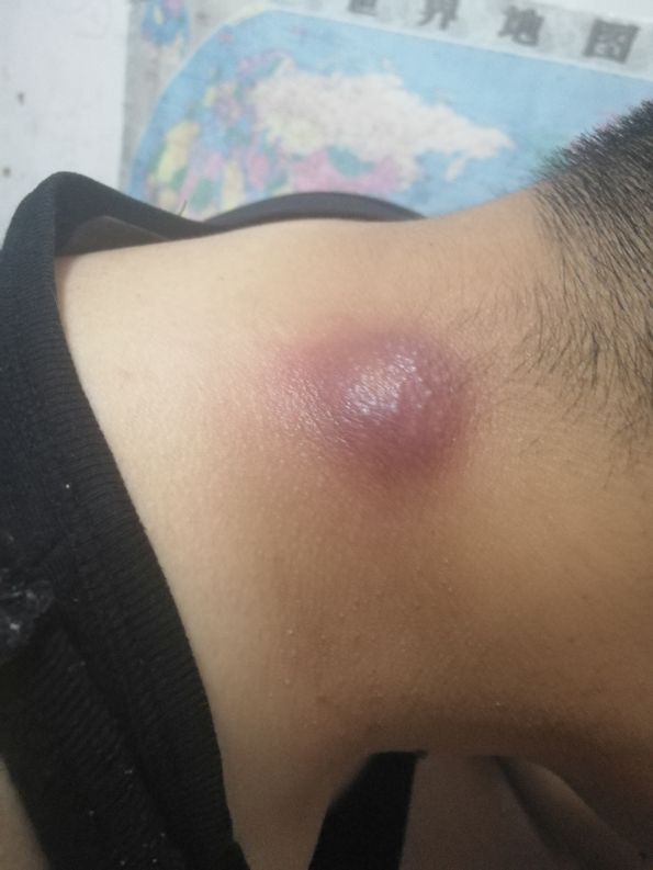 无麻痛不欲生,火疖子引流手术亲身经历