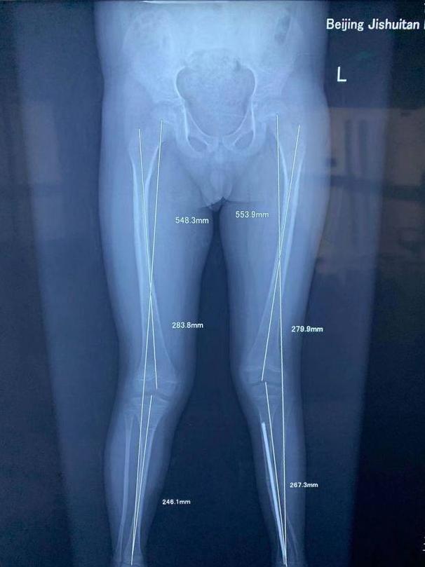 儿童左右腿骨骼发育不一致,2岁男童走路好像腿软总是摔倒