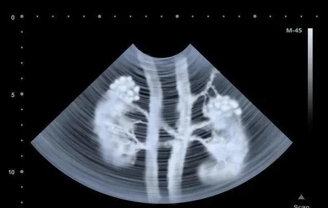 透析对肾脏衰竭的人有好处吗,心脏衰竭肾脏衰竭透析能活多久