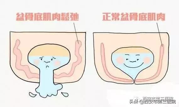 【盆底功能康复治疗】关爱女性盆底健康远离女性“社交癌”