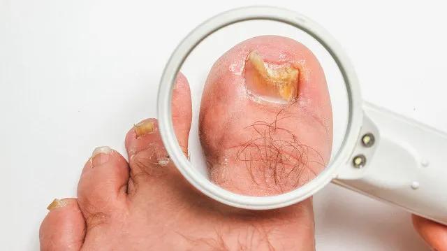 去修脚店治疗灰指甲需要多少钱,灰指甲医院治疗多少钱