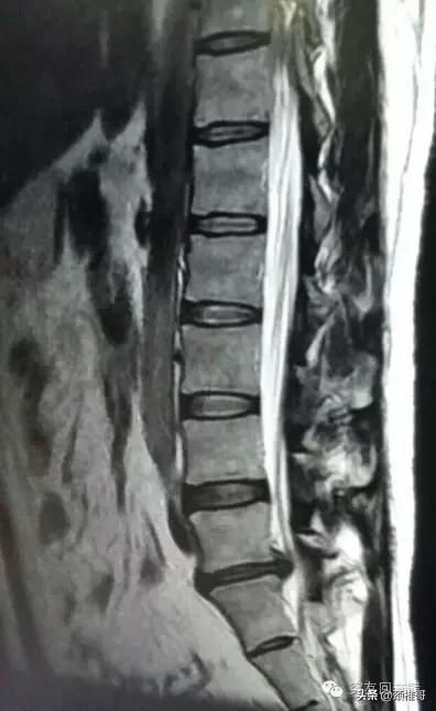 腰突椎间孔镜手术后复发怎么办,腰突做椎间孔镜手术到底好不好