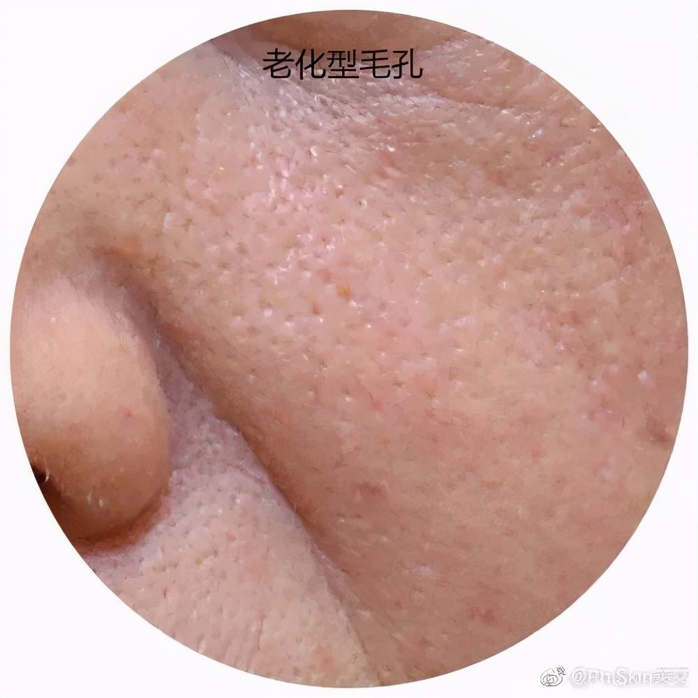 解决毛孔粗大最有效的方法,毛孔粗大有黑头喝中药调理可以吗