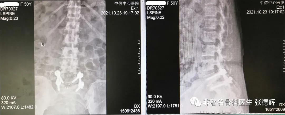 腰椎真性滑脱，手术复位融合固定