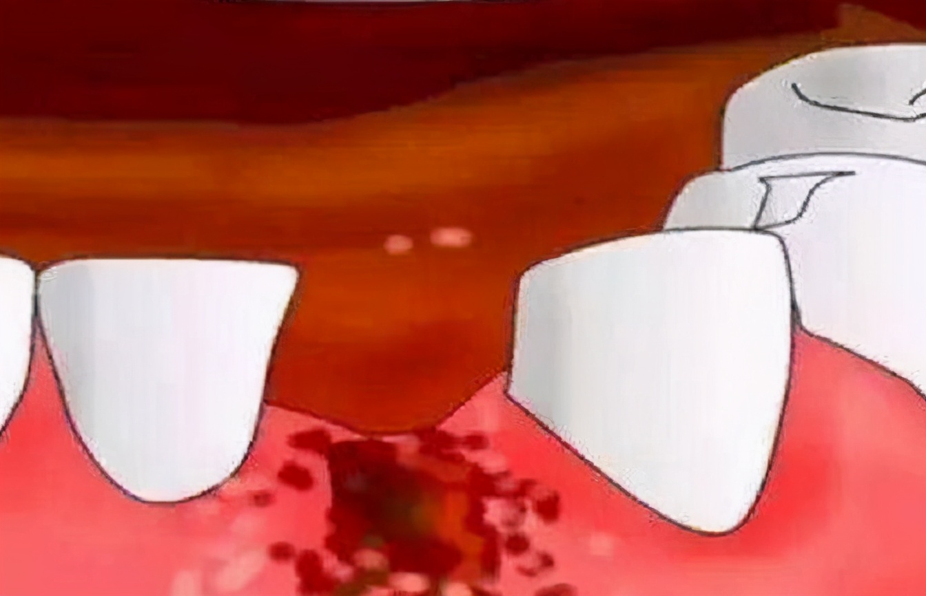 拔智齿干槽症能自愈吗需要多久,拔智齿一般是几天知道干槽症