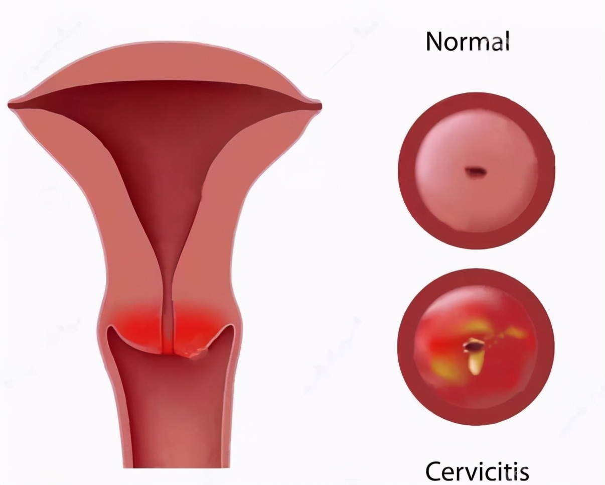 慢性宫颈炎传染吗,慢性宫颈炎严重吗好治愈吗