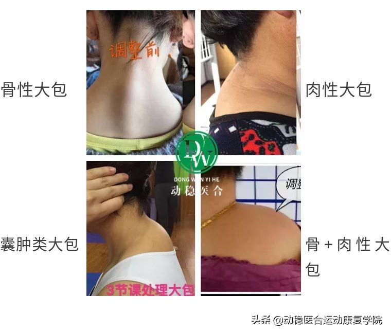 肩背颈椎的康复动作,后背式呼吸好处