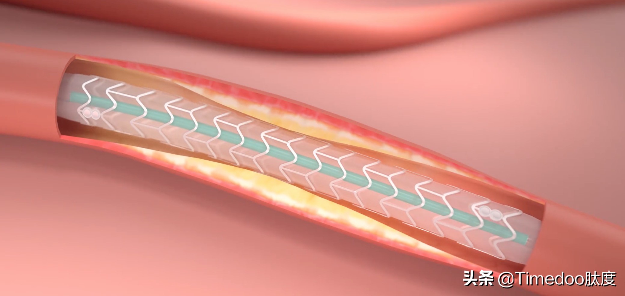 心跳科技的力量|乐普医疗推出首个国产生物可吸收支架