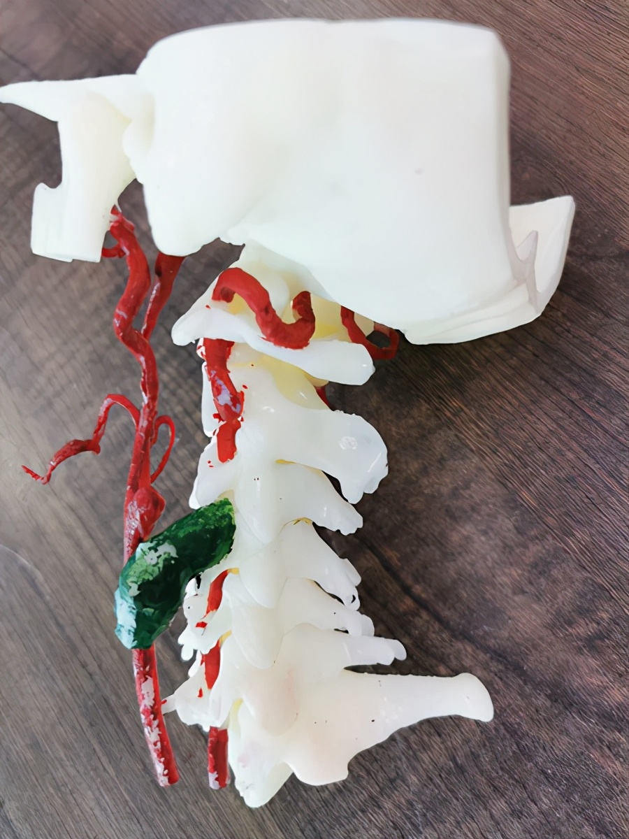 颈椎肿瘤切除术3d动漫演示,颈椎3d打印手术