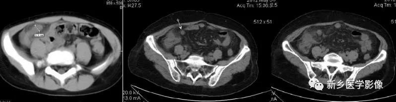 阑尾的ct解读与影像诊断技巧,阑尾影像学基础知识