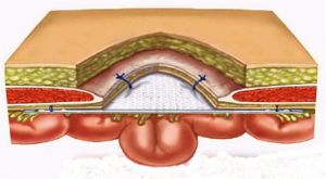 老年人腹壁切口疝用腹带效果如何,腹壁疝术后睡觉要绑腹带吗