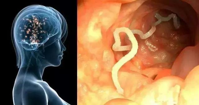 28岁小伙癫痫16年，脑子被虫吃了！竟因爸爸给他吃这个“大补”