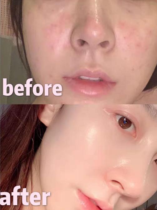 长痘期间推荐的面膜,拯救不闷痘的面膜