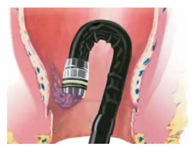 做肠镜喝泻药痔疮出来了怎么办,肠镜检查发现有痔疮可以切掉吗