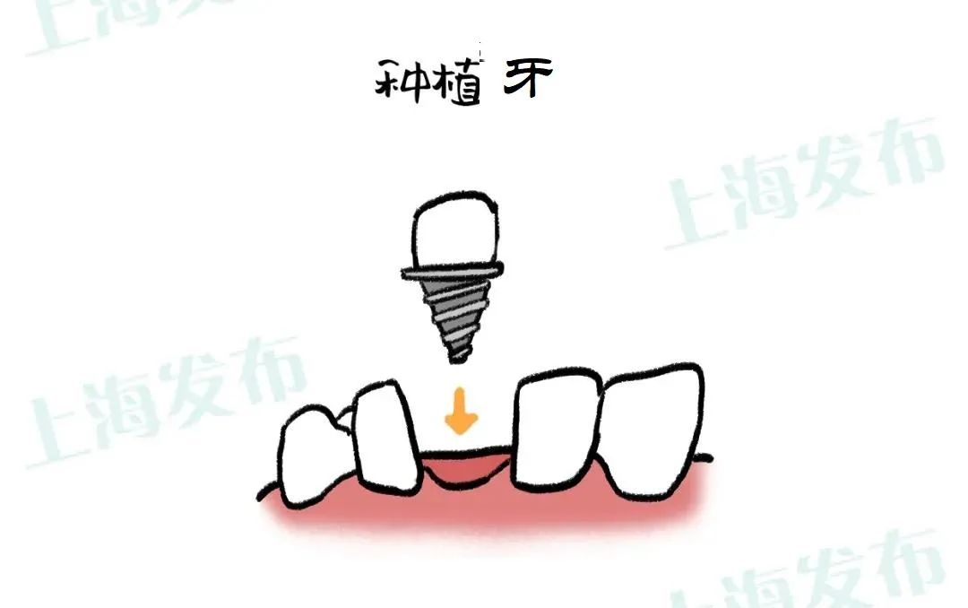牙疼牙医把牙神经断了会怎么样,牙疼要不要毁掉牙神经