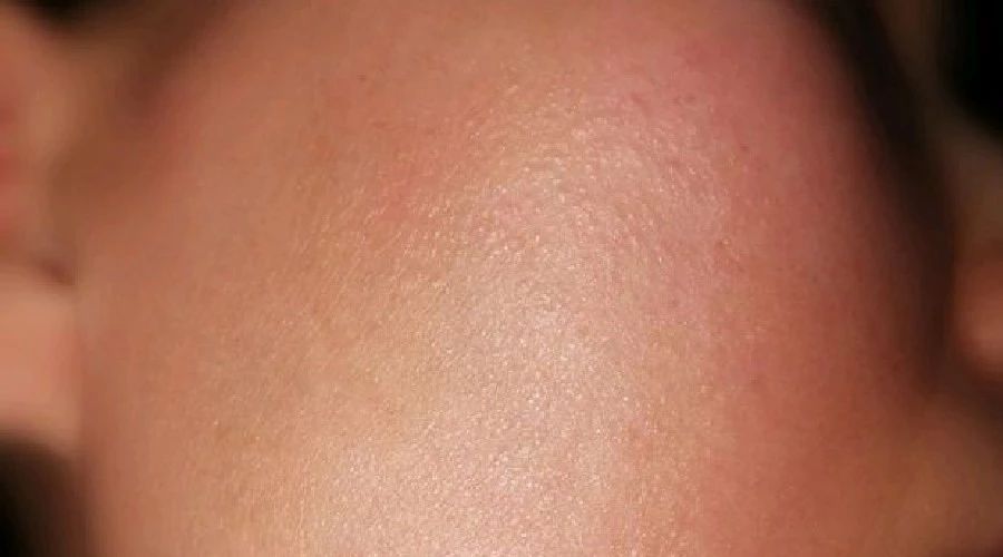 逆光疹跟皮肤屏障受损有关系吗,逆光疹一定是皮肤屏障受损吗