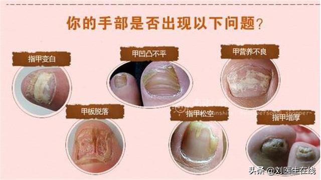 灰指甲怎么治好得最快小妙招,灰指甲怎么治才能彻底根除