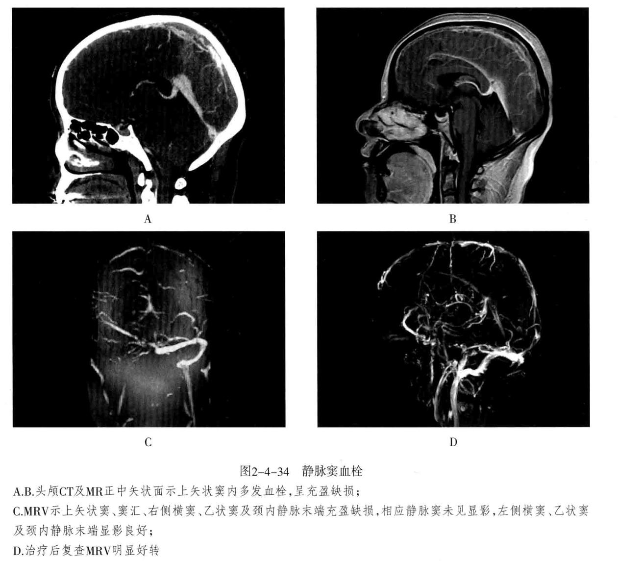 颅内血管周围间隙的影像鉴别,颅脑血管源性疾病影像诊断