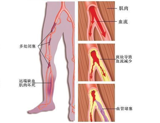 抽筋是什么原因引起的抽筋怎么办,着凉抽筋和缺钙抽筋的区别