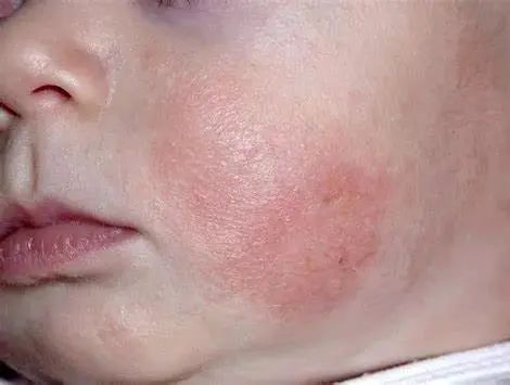 得湿疹了自己会好吗,得了湿疹要忌什么