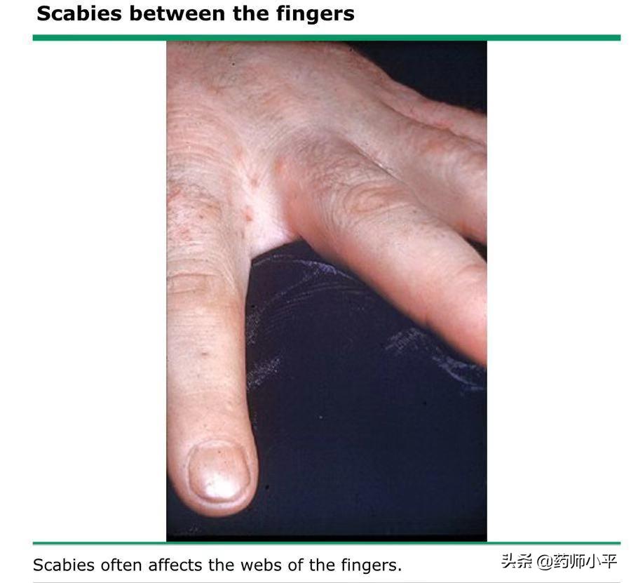 脸部反复过敏跟螨虫有关吗,脸因为螨虫过敏怎么治疗