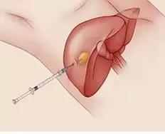 发现肝脏结节要做哪些检查,发现肝部有小结节用治疗吗