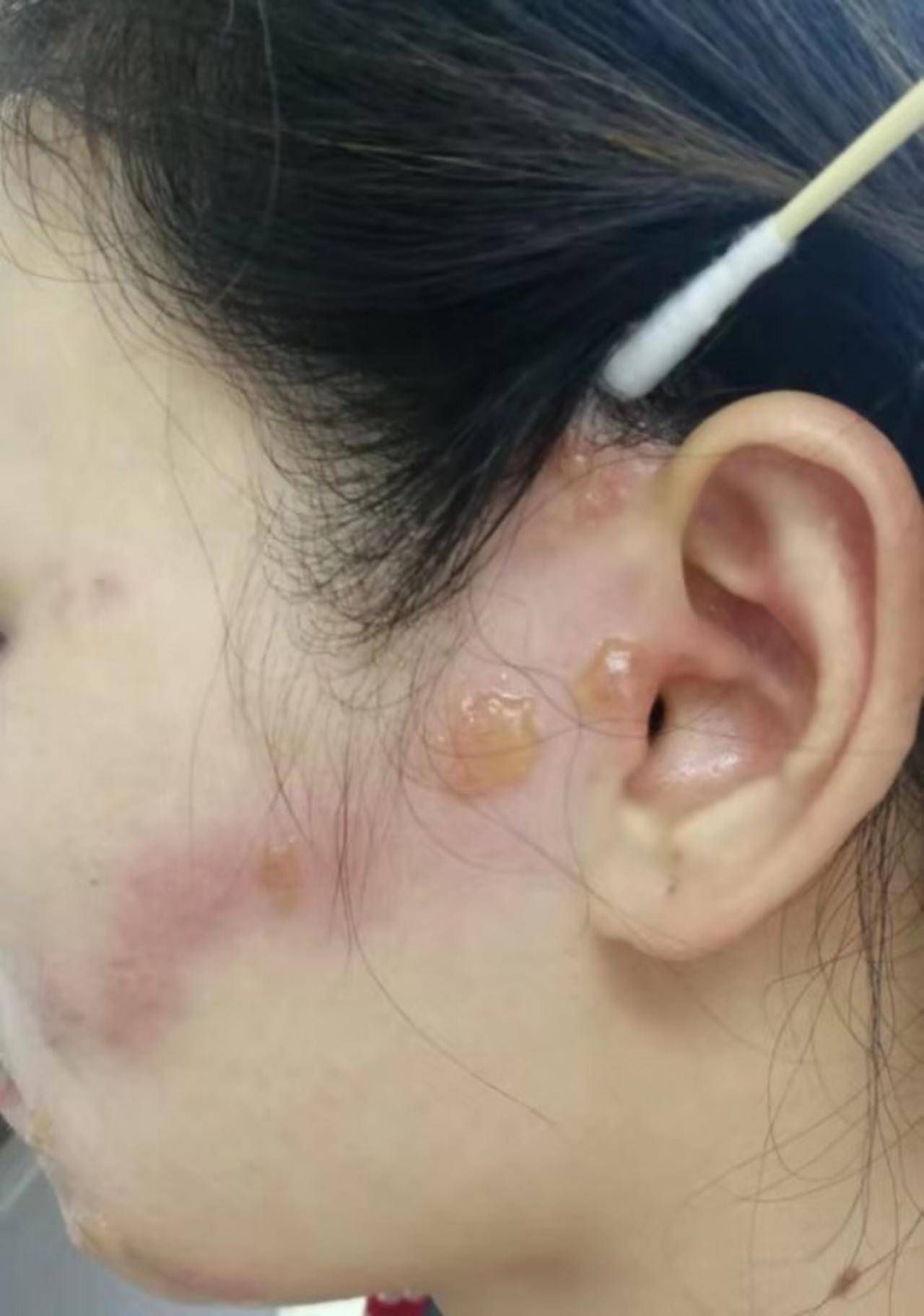 女子脸上长个大包,女子脸上长了一个特大的包