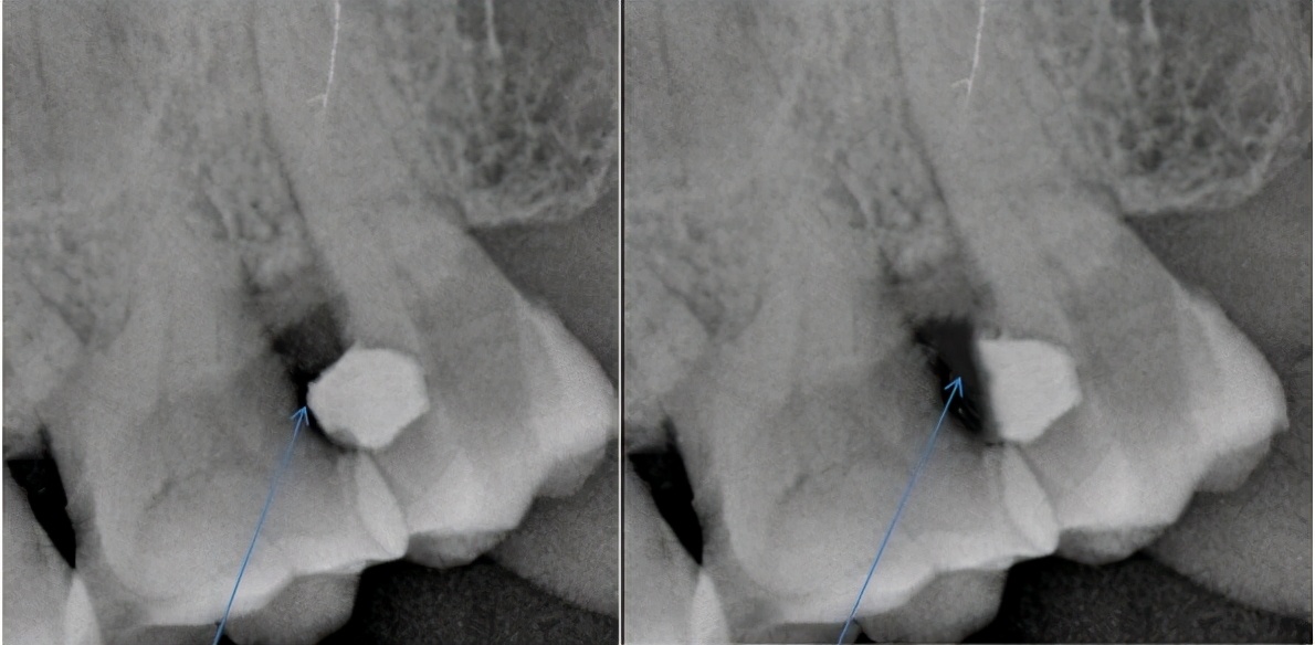 补牙后敏感遇冷热疼痛,补牙后牙齿敏感怎么处理最好