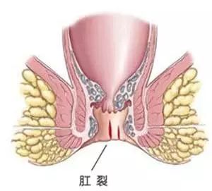 肛裂难言之隐,肛裂难以治愈