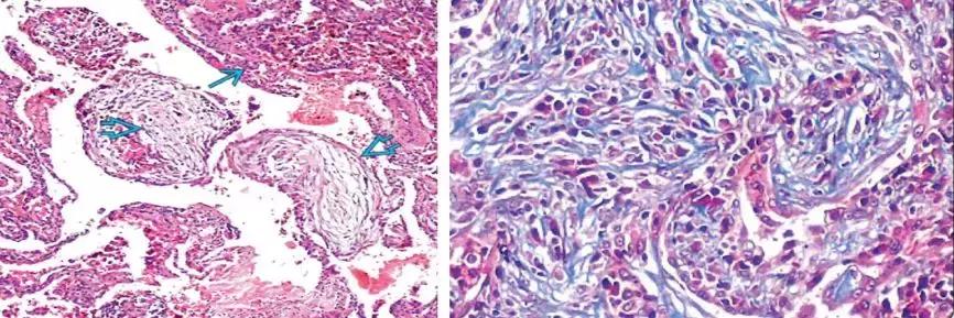 机化性肺炎平时应注意什么,机化性肺炎的正规治疗