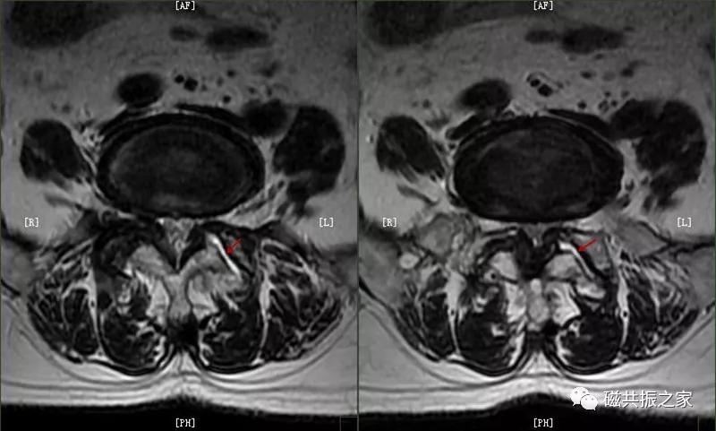腰椎有哪些病变,腰椎病变有几种