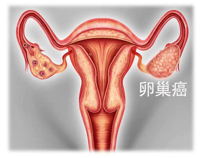 大妈肚子疼一周未重视，检查发现已是卵巢晚期