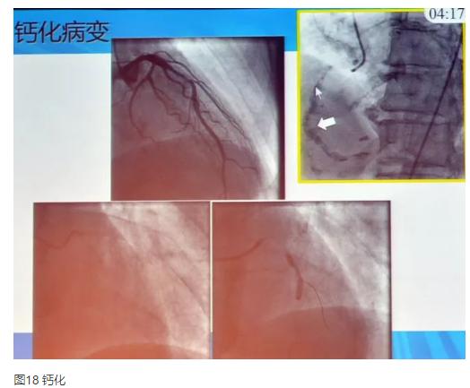 清晰完整揭秘冠脉造影全部过程,冠脉造影教学视频