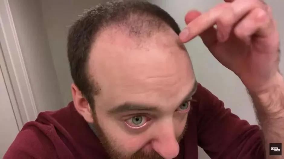 喝凉水容易掉头发古人头发少怎么办？