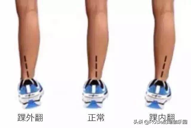 膝盖内扣扁平足怎么矫正,膝盖内扣怎么矫正腿型13岁