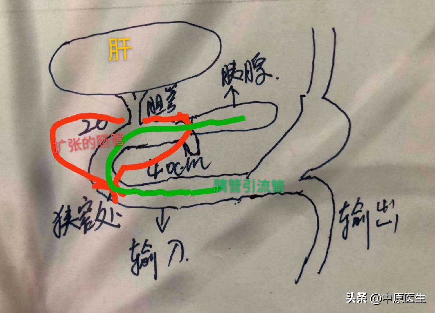 团队工作：老太太患黄疸规范治疗后仍高烧，转到介入科很快治好了