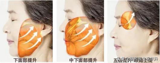 拉皮手术变化如何值得做吗,做了拉皮手术到老了会不会很难看