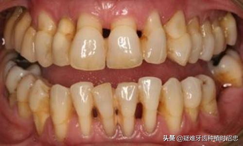 比较严重的牙周炎,时不时会流牙血应该如何治疗？