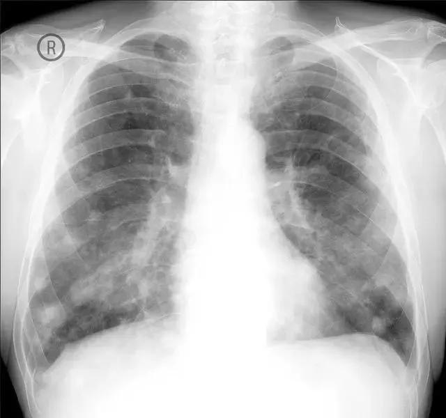 感冒1天了还没好怎么回事,感冒1个星期不好正常吗
