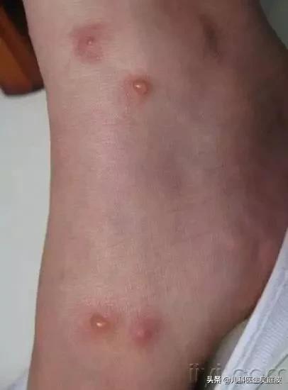 丘疹性荨麻疹是麻疹吗,丘疹性荨麻疹用了药还是痒